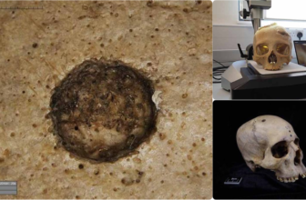 Historical Egyptians Tried to Surgically Deal with Most cancers, Examine Finds